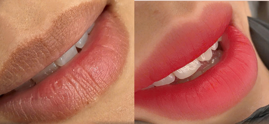 Dark Lip Neutralization result